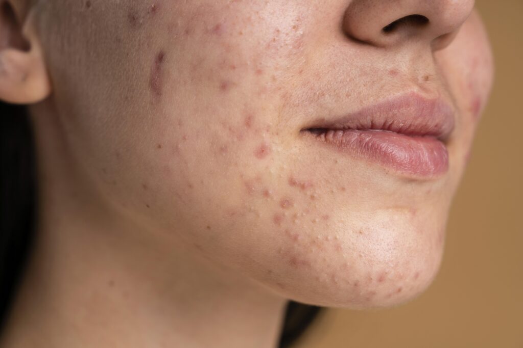 acne treatment in kondapur