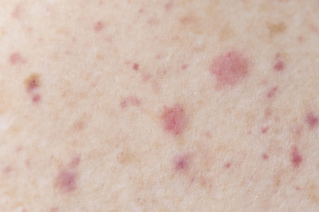 Dermatologist examining folliculitis with red inflamed hair follicles on the skin at ZAHA Skin, Hair & Aesthetics Clinic in Hyderabad.