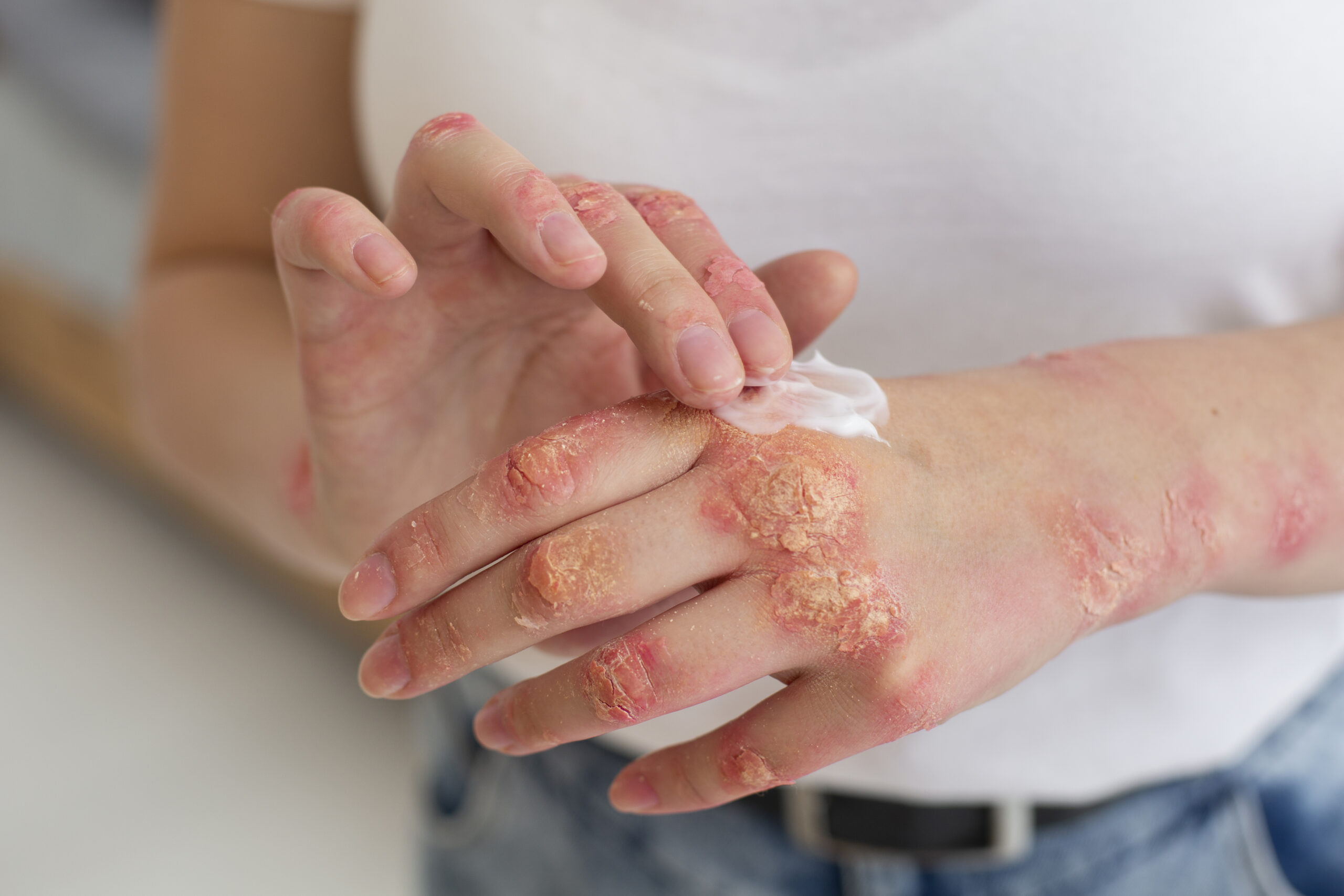 Psoriasis treatment for scaly and inflamed skin by a dermatologist in Kondapur, Hyderabad