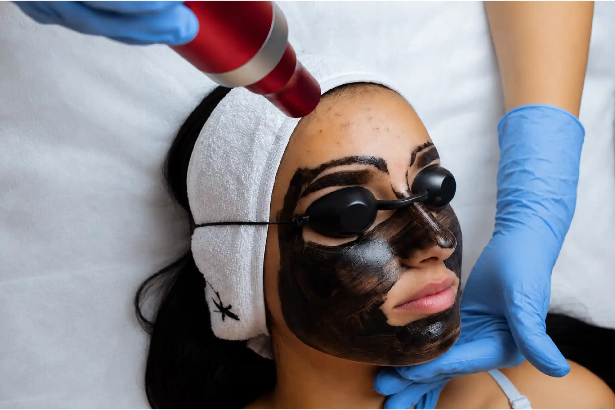 Carbon-Laser-Peel-Treatment