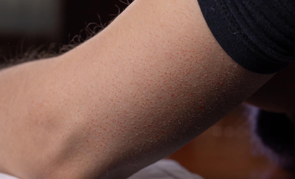 Keratosis-Pilaris-DermatologyKeratosis-Pilaris-Dermatology